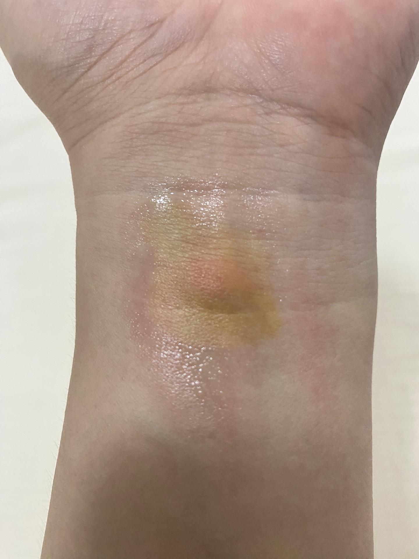 蚊虫叮咬。什么玩意咬的啊，硬邦邦的一个小疙瘩，还奇痒无比，有知道的么？...