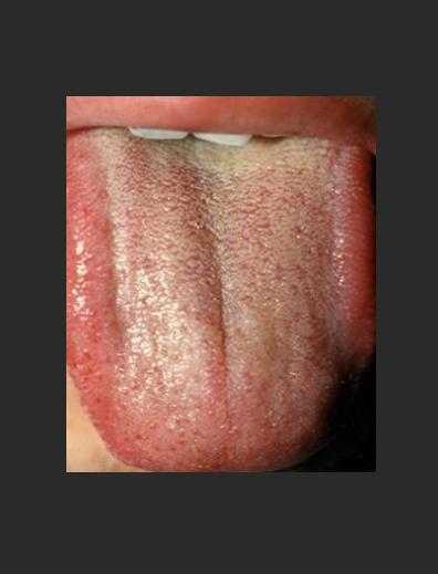 这种肝郁舌象，用逍遥丸，柴胡舒肝也无济于事！其实病情早就发展了

老李最近总觉得