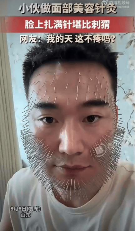 想必效果一定很好吧！山东，一小伙子做面部针灸美容，脸蛋上密密麻麻扎满了细针，远远