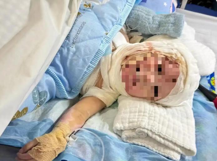 广东不满一岁的男童，全身85%的皮肤被汽油火焰吞噬。12月6日转入医院时，这个体