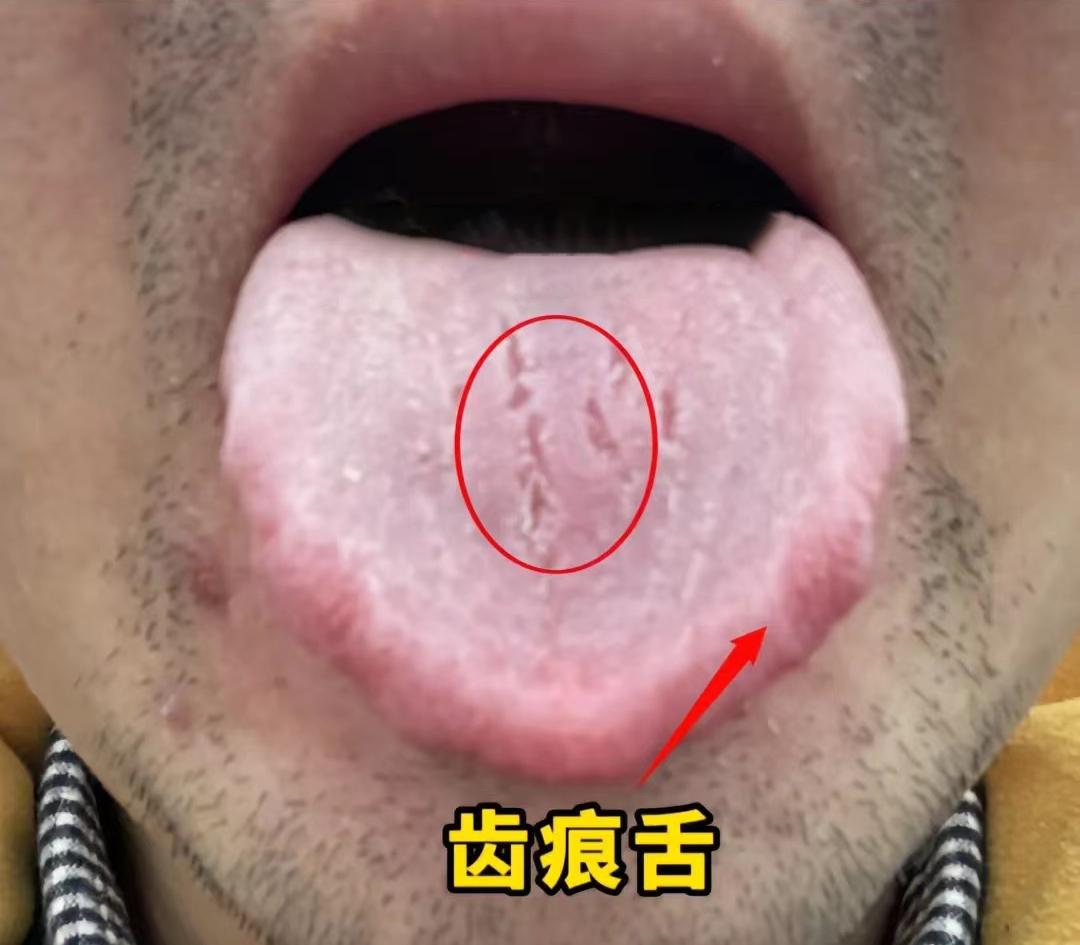 最近碰到了好多，30来岁病友，都是难言之隐[捂脸]
要么硬度不好，要么起不来，要
