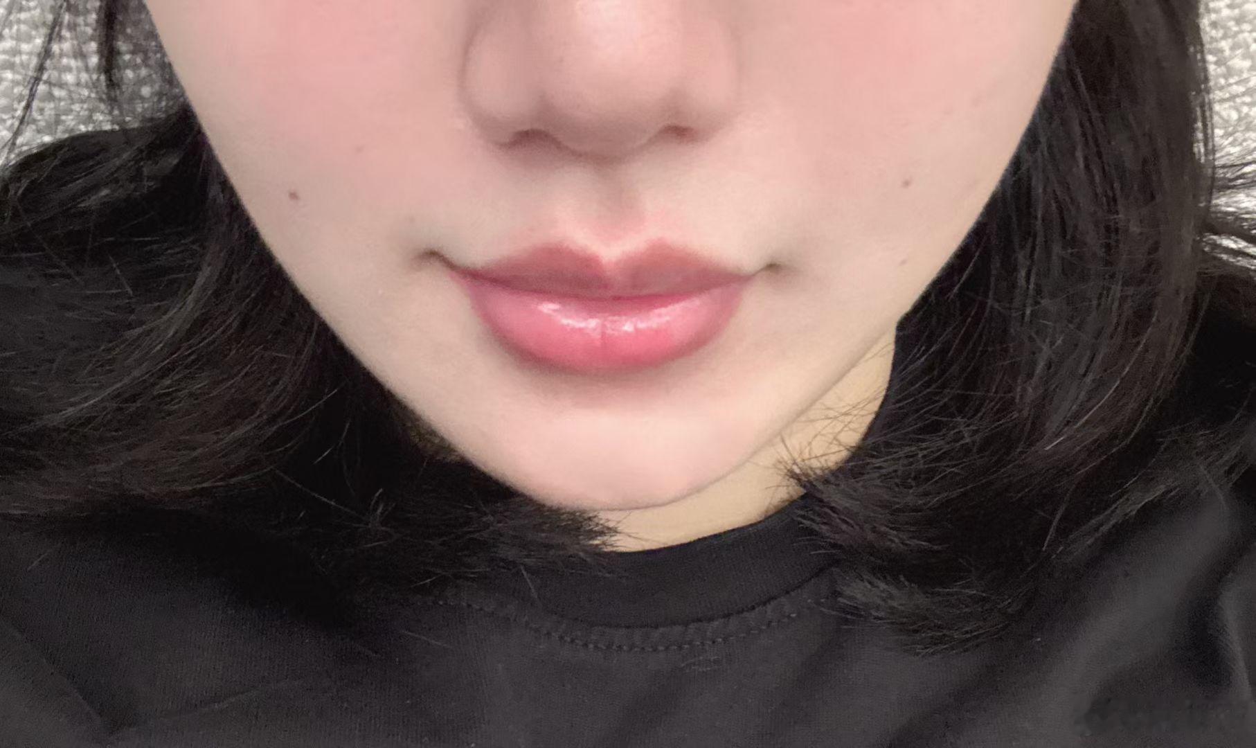 琳波医美 谁想亲 🙋♀️ 