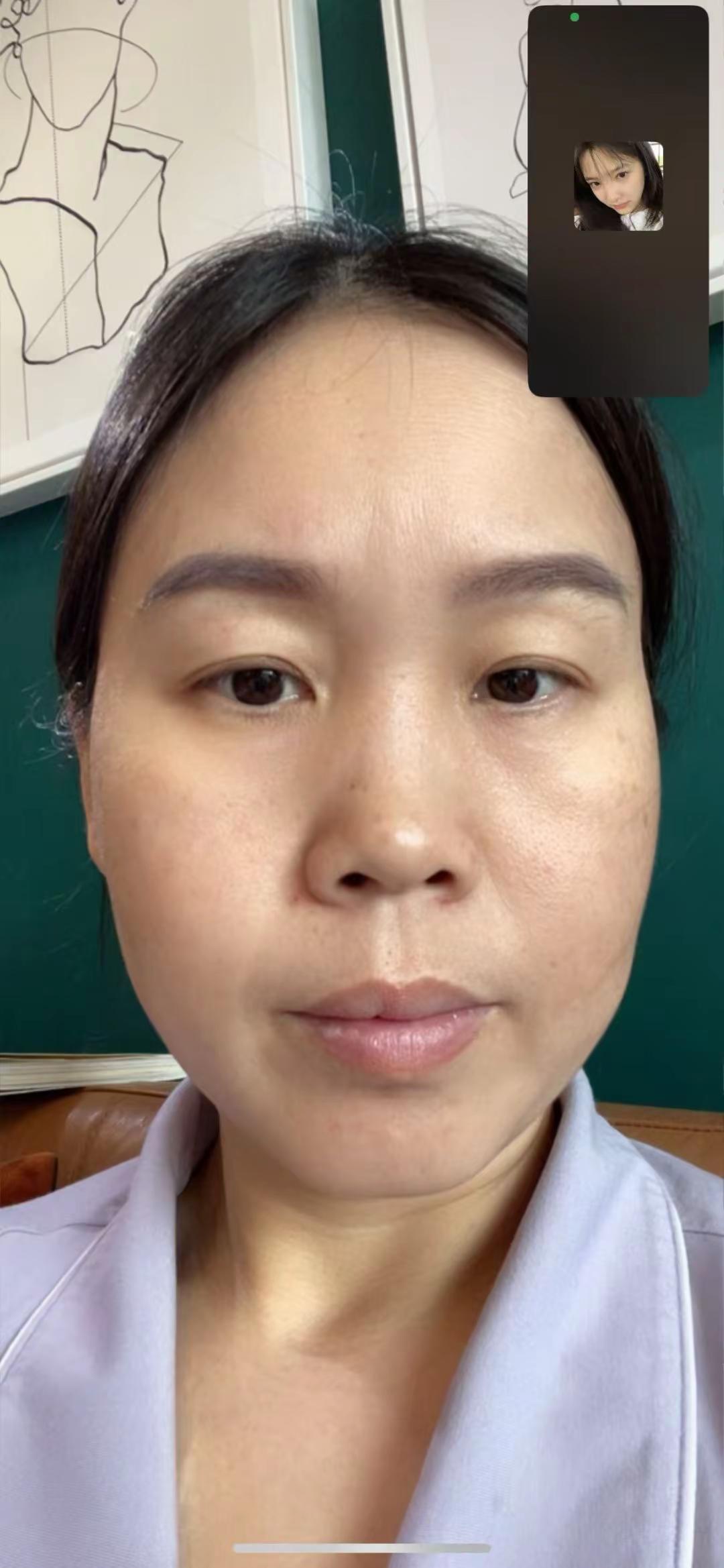 我两姐妹的蜕变，朋友们看到都说比之前年轻了许多，终于在解决了我多年的烦恼😂