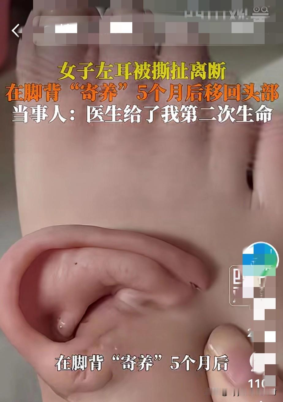 听说过，把手放在肚子上寄养的！今天又大开眼界了，医生竟然把女子的耳朵，寄养在了她