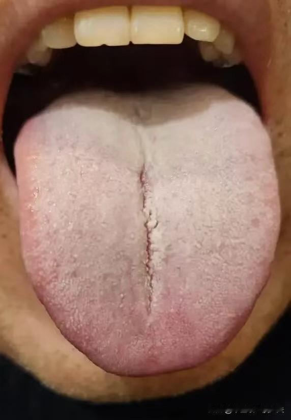 国医李可曾言：凡脾胃病，健脾准无效，必须用四逆！
尤其像这样的舌象，很容易被误诊