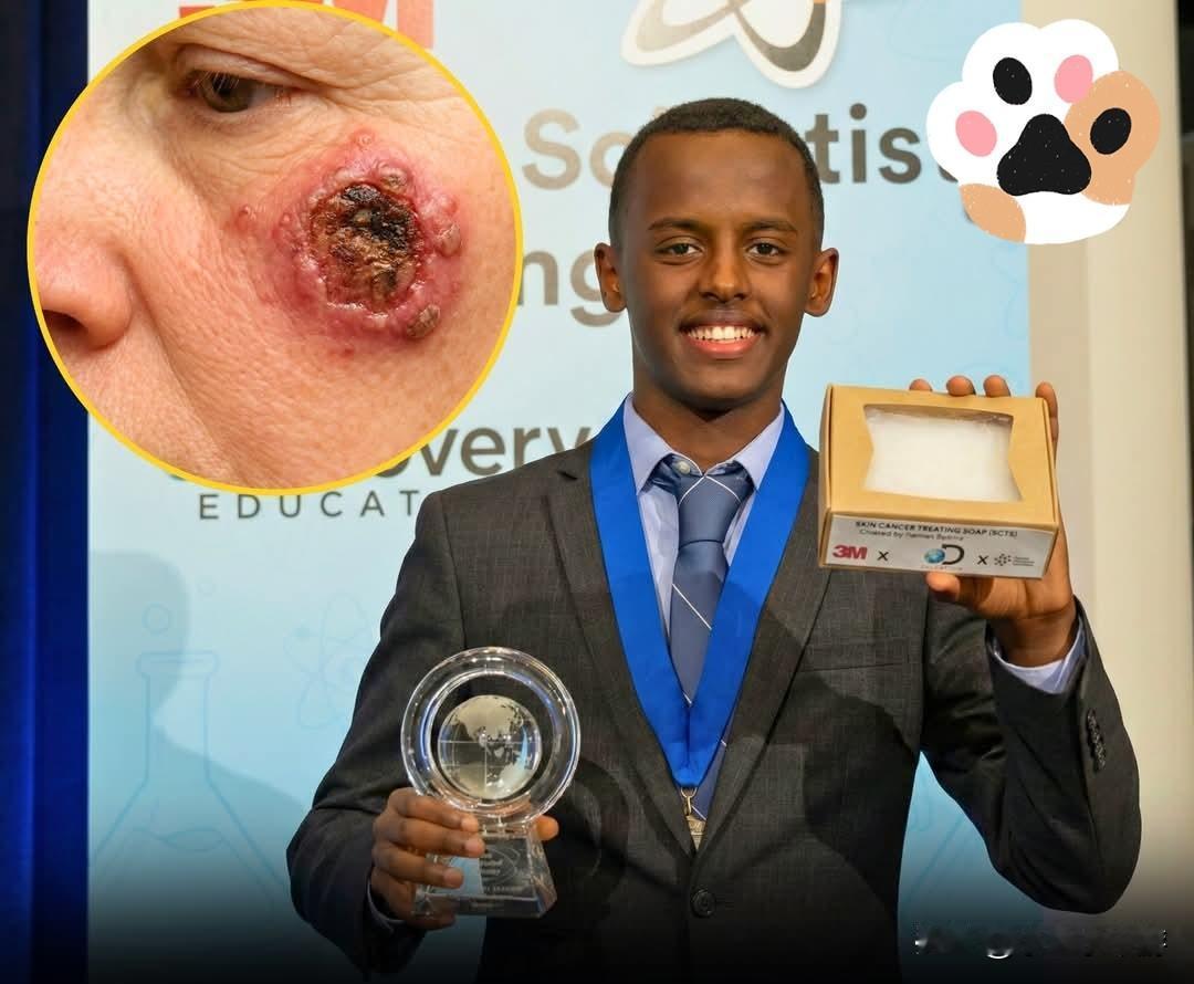 年仅14岁的赫曼·贝克莱，凭借发明一款用于治疗皮肤癌的低成本香皂，获评“美国顶尖