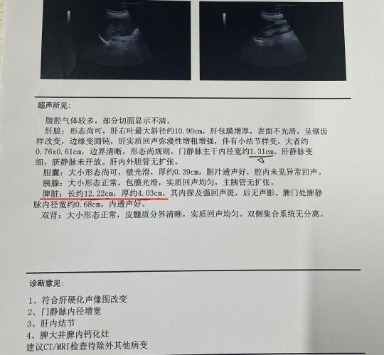 肝硬化脾大不一定都缩脾，尤其是在早期，保守治疗的效果也非常好，像这位患...