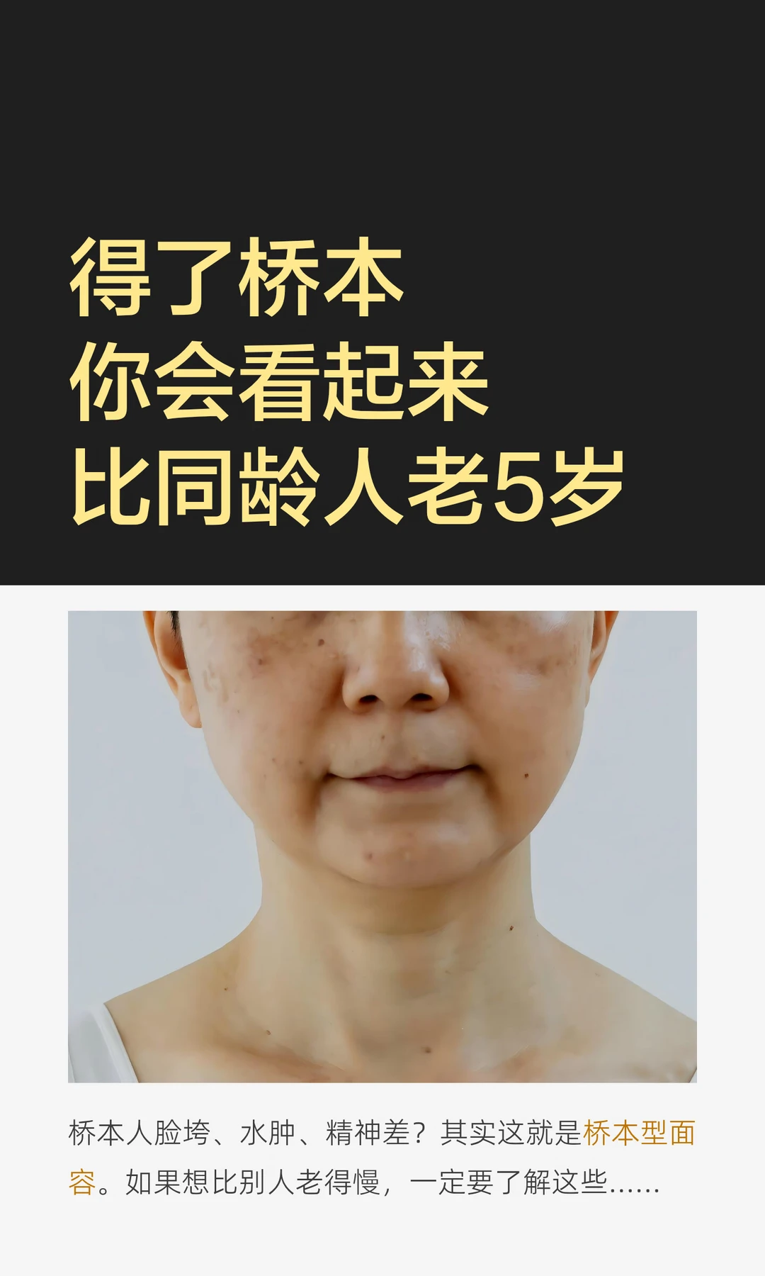 水肿、脸黄、脸垮、脱发|桥本型面容怎么办