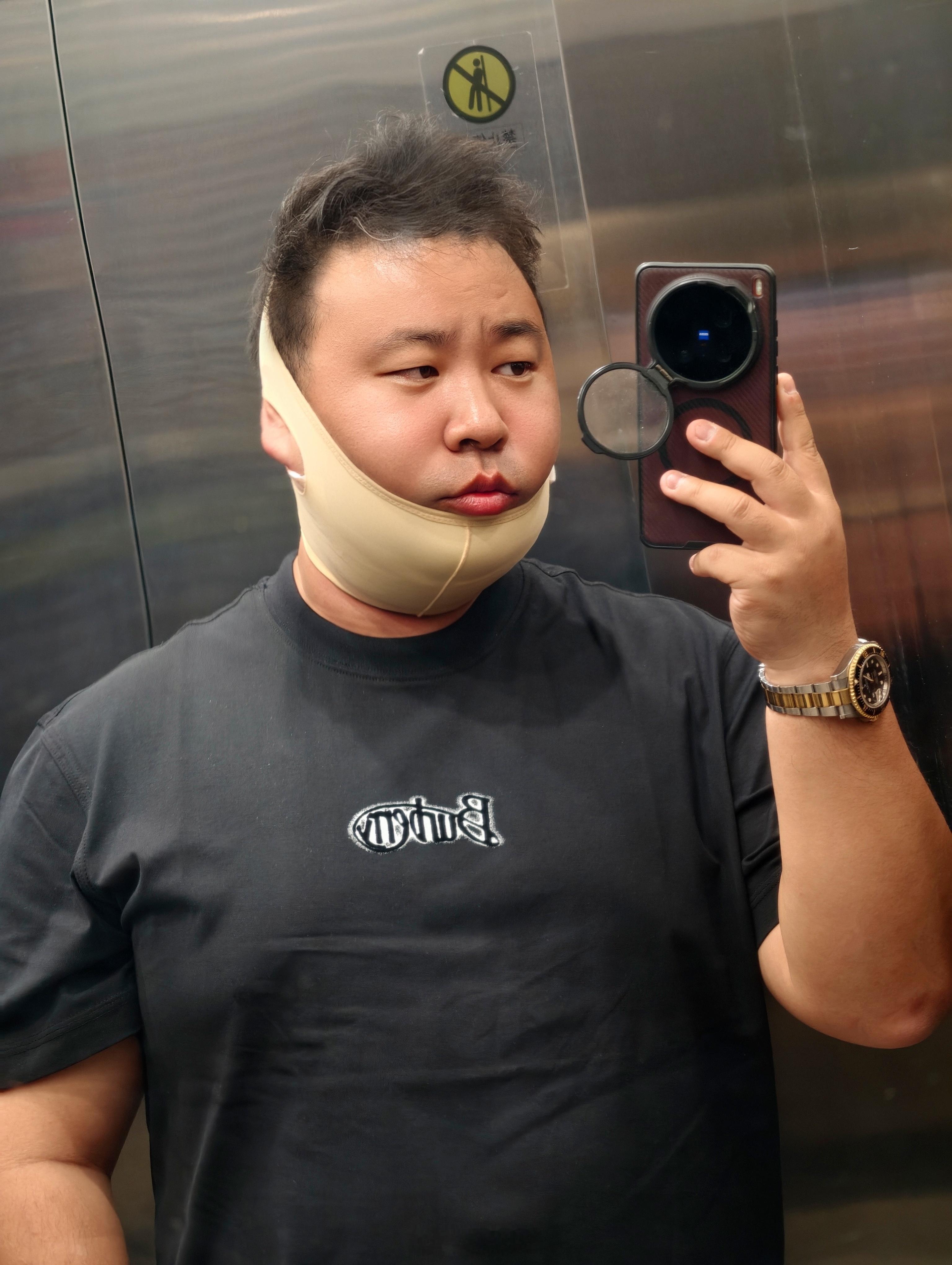 无论怎么努力的减肥，双下巴还是特别明显。既然如此，那就直接物理性解决吧~医美 直