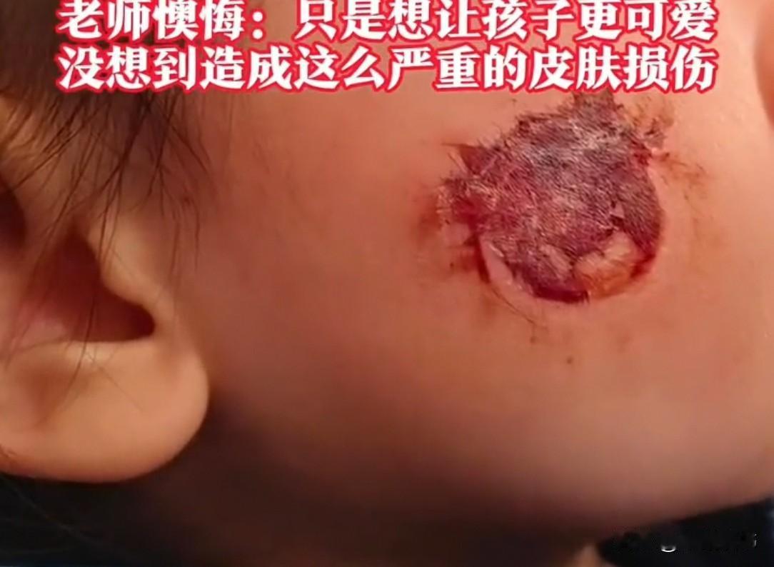 湖南一幼儿园里，3岁女童低着头慢慢走进教室。老师凑近一看，孩子脸上一片糜烂，她顿