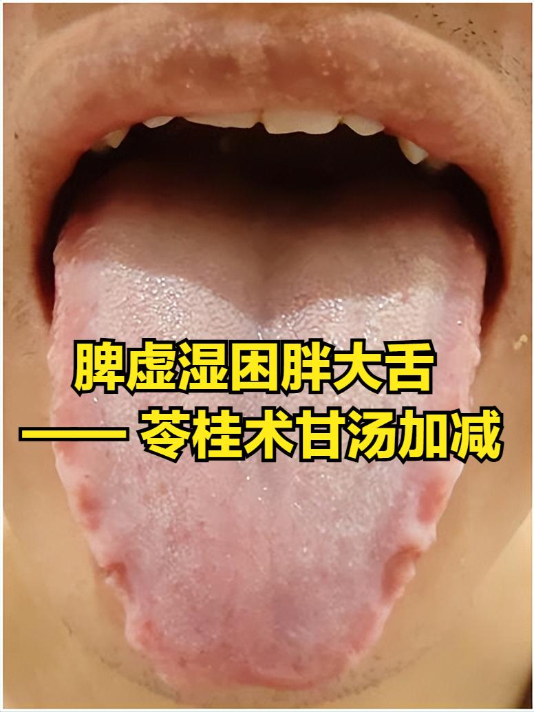 脾虚湿困证（胖大舌）的舌象解析及苓桂术甘汤加减调理
中医认为“脾主运化水湿”，脾