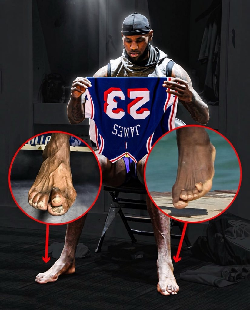 老詹这个脚的变形是不是更严重了[允悲]NBA[超话] ​​​