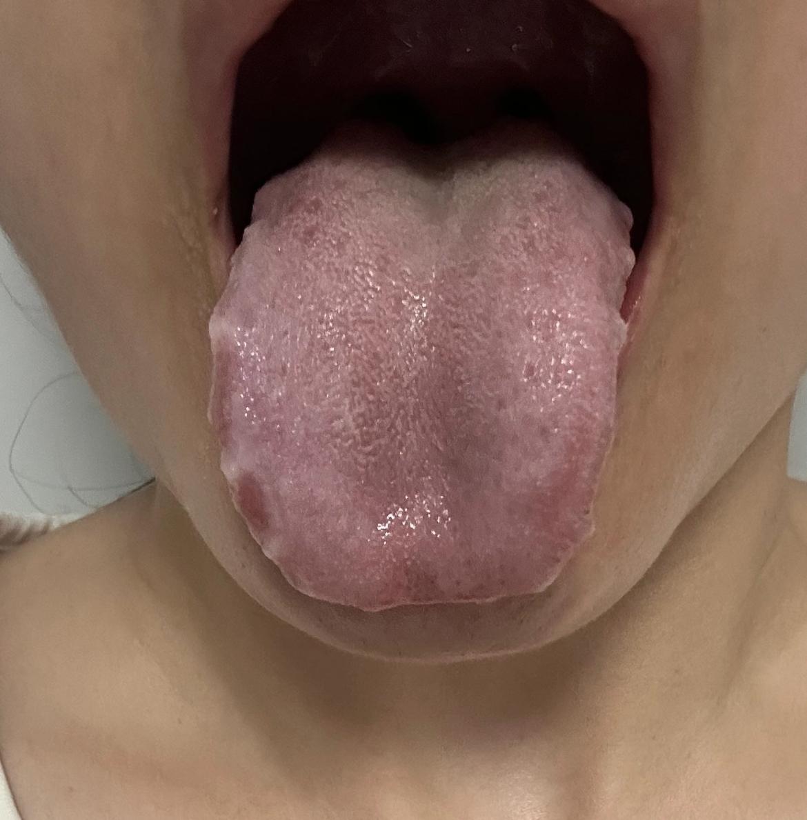 门诊遇到一位病友，情绪特别急躁，爱生气的
如果你跟他的舌头一样，千万要记好这两点
