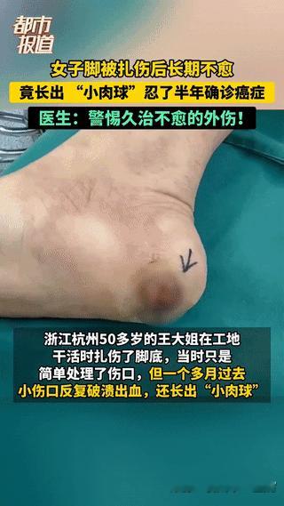 “悲剧还是发生了！”浙江杭州，50多岁的王大姐在工地干活时不小心扎伤了后脚跟，当