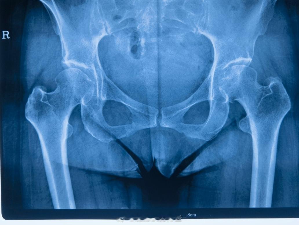 #医生看片大会# 又是在当地医院按着腰椎治疗了俩月，最后来了发现是髋关节的问题的