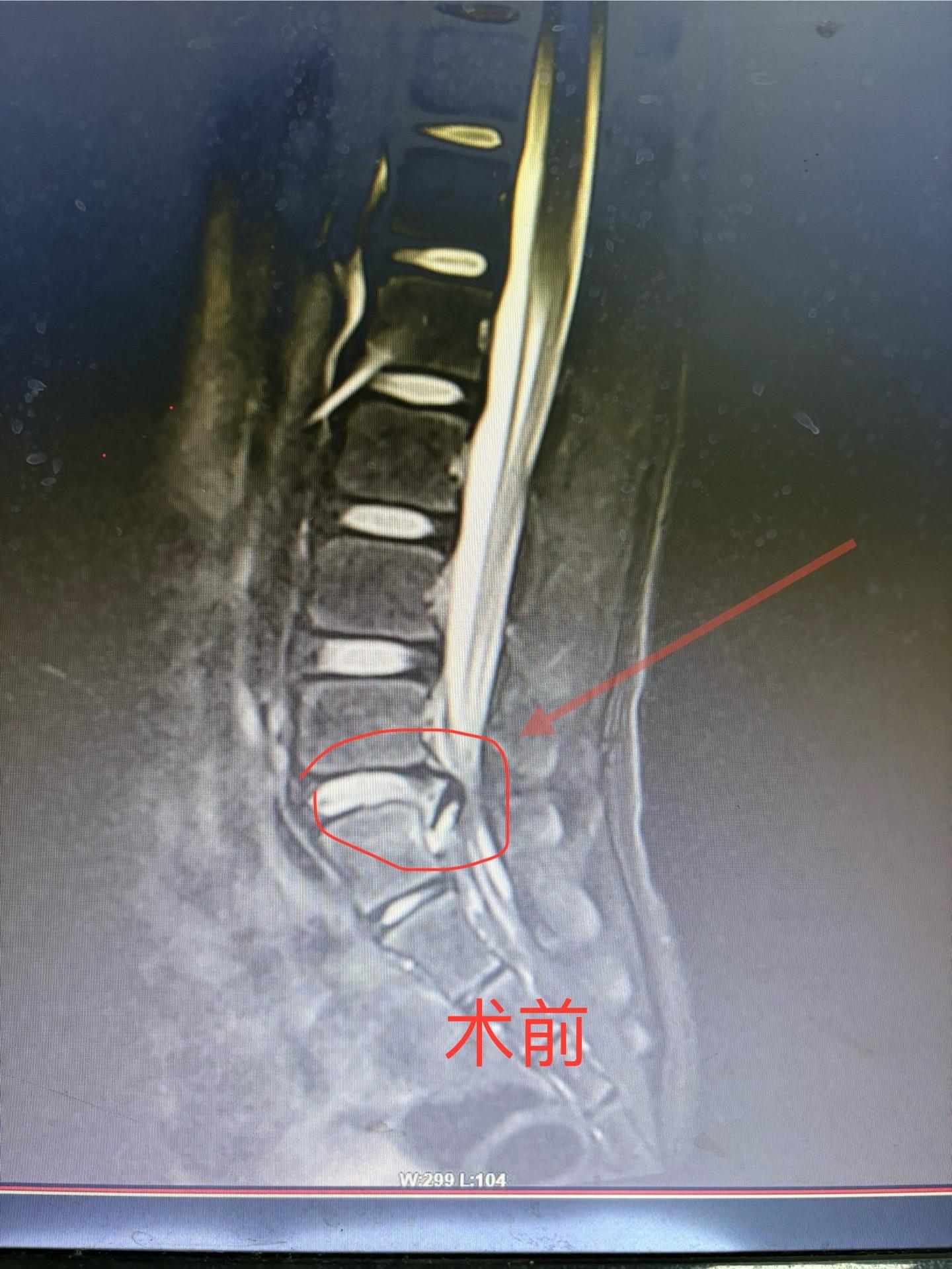 极度罕见年轻椎间盘脱出。十一岁。当时一直想保守治疗但效果不佳，走路都困...
