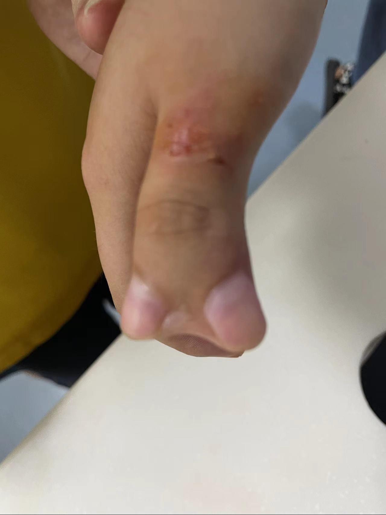 假期是小朋友多指比较多，这个小朋友十岁了，年龄有点大，但是做总比不做的好。