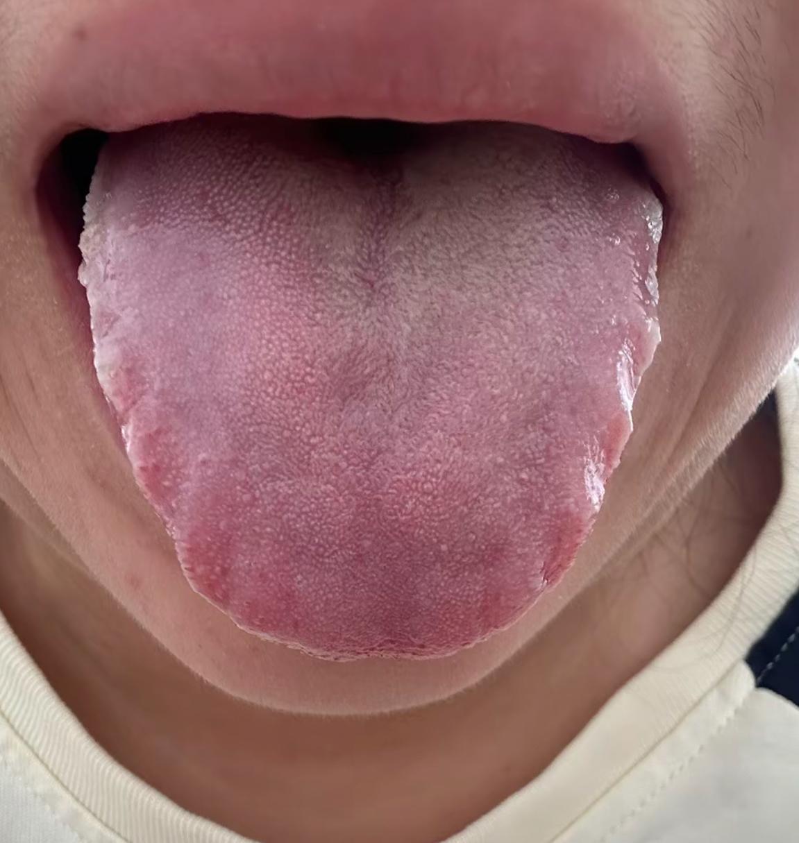 这位男粉丝，一大早发来舌象，真的震撼到我了
你也太能造了吧？舌头皱皱巴巴，一圈齿