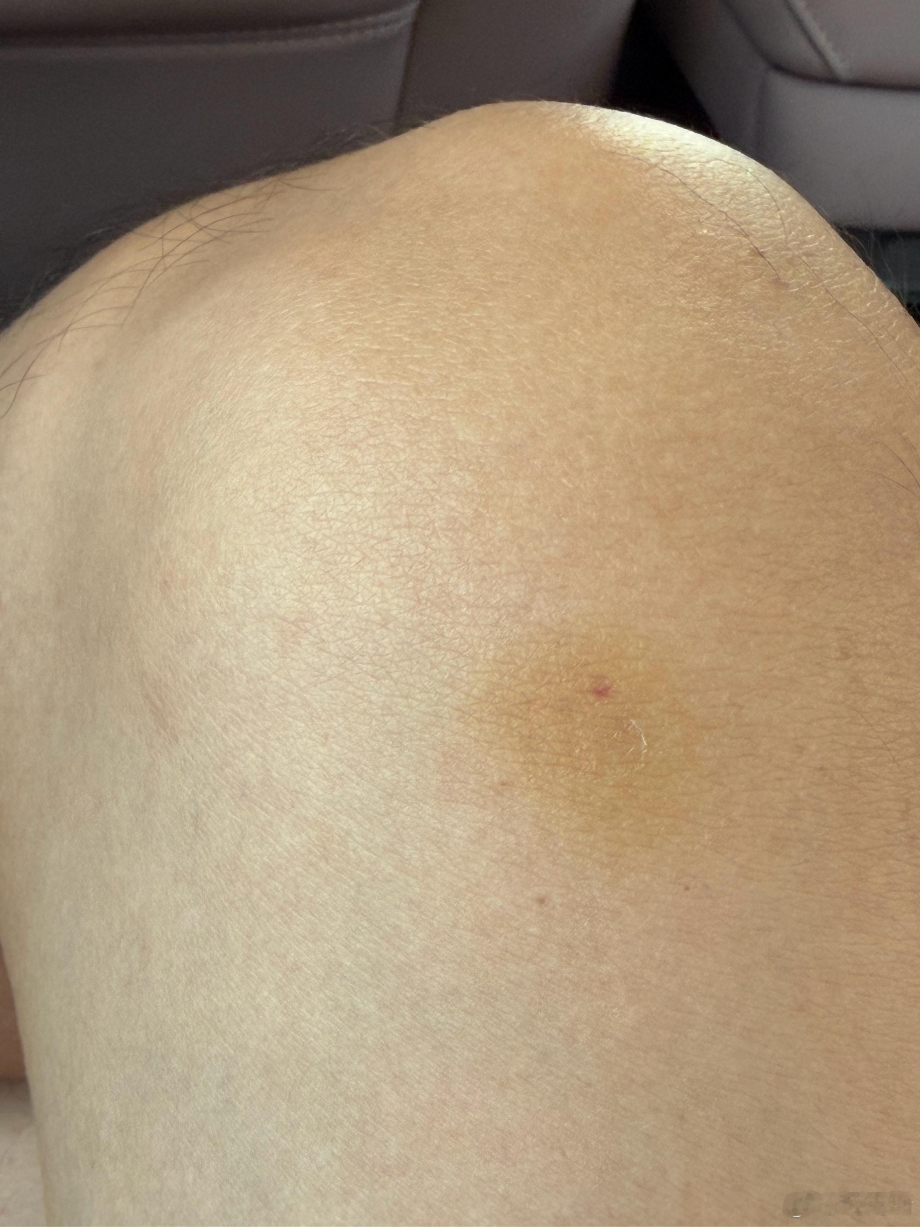 突然发现腿上不知道什么时候被撞的地方变色了，就是老话说“青一块紫一块”。紫一块是