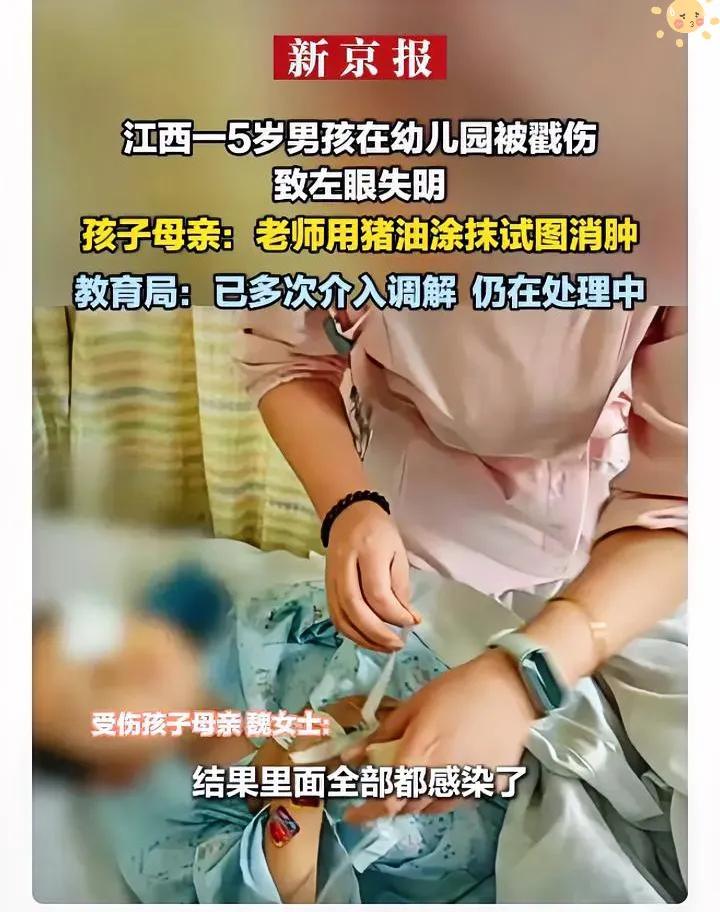 5岁娃幼儿园被戳瞎左眼！老师竟用猪油消肿，这操作太离谱
 
真的看完心都揪紧了！