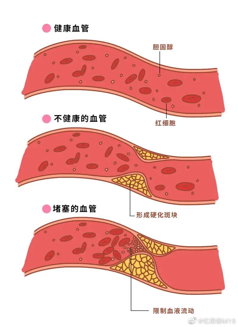 血管好，不堵塞，做好这五件事。1. 平常注意饮食，特别是喜欢吃肥甘厚腻食物的朋友