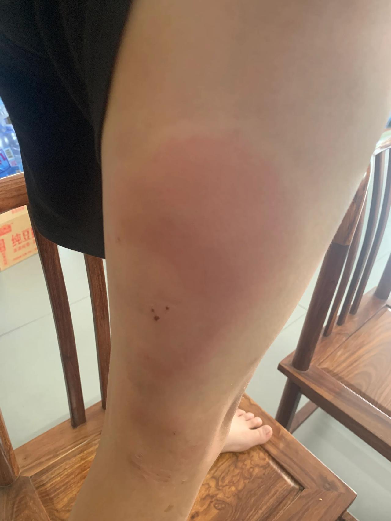 天啊，看到儿子的腿不知道被什么咬了，心疼得很，婆婆说不用去看，说只是给蚊子咬了，