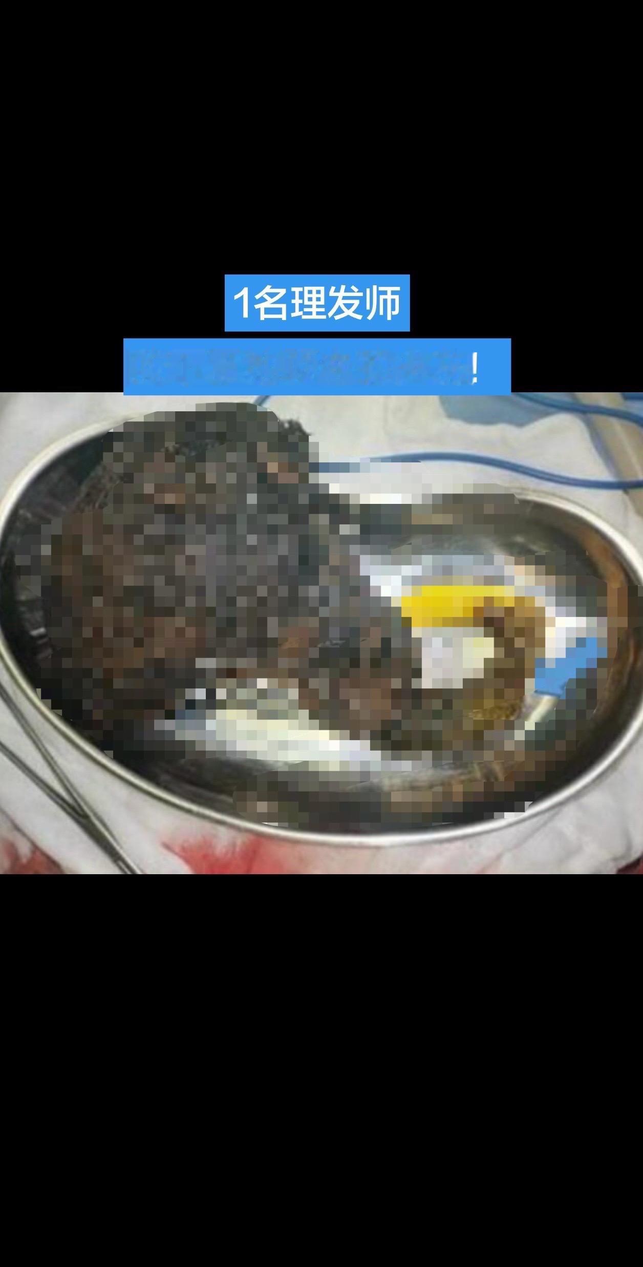 一名19岁理发师因剧烈腹痛、持续呕吐前往医院就诊。

医生在她胃里发现一个巨大毛