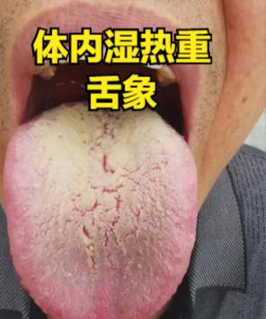 舌苔黄腻，体内湿热重，吃了清湿热的药没效果？多是你没有对症下药
湿热停留在不同的