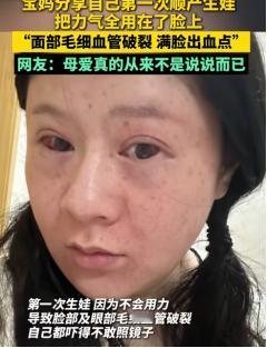 心疼！2024年11月10日，山东有一孕妇第一次生孩子，顺产时力气都用在了脸上，