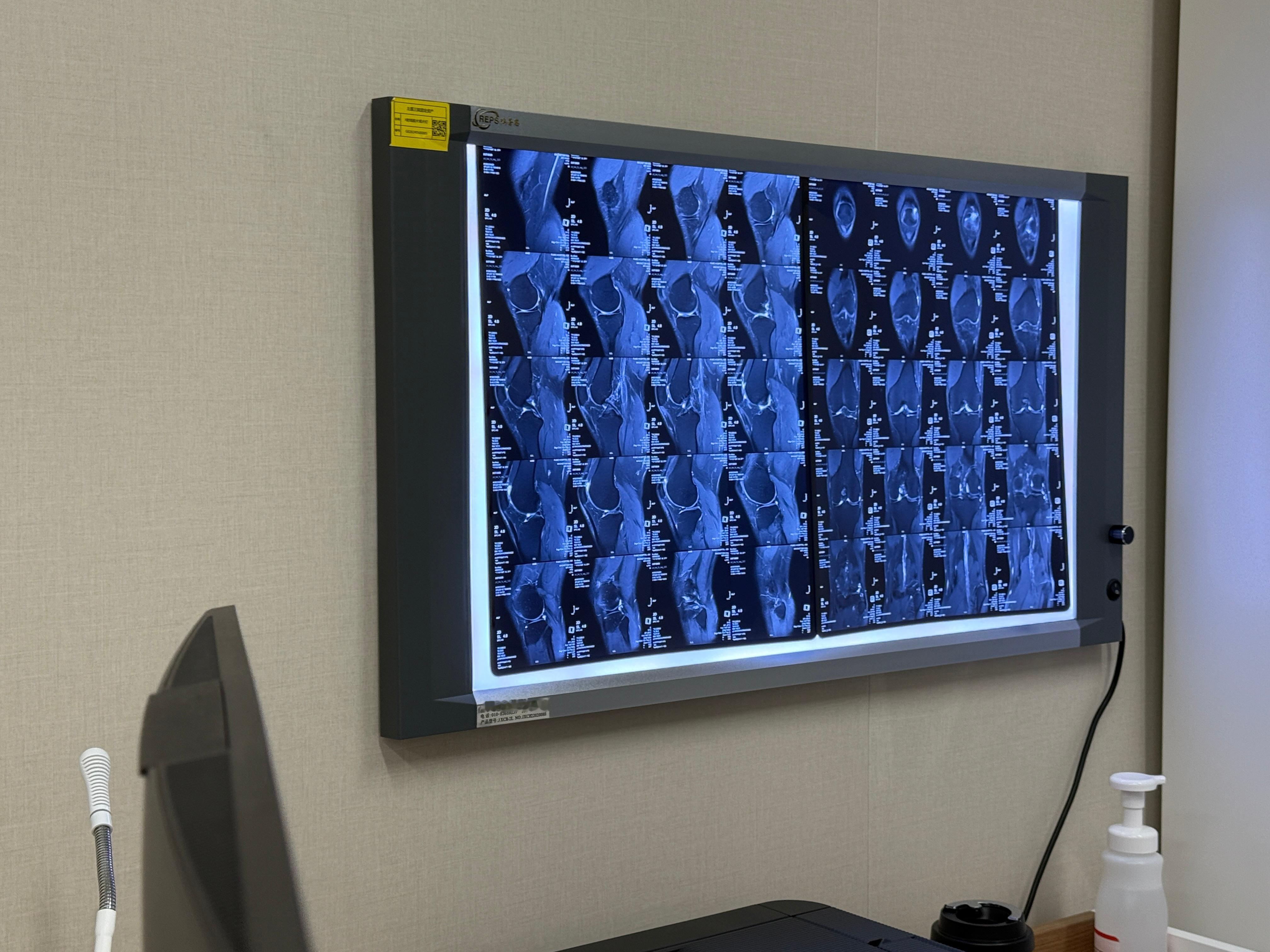 又来看膝盖了，距离菱帅撞墙已经一年了，还没好，急死人了。大夫说不错了，你这髌腱没