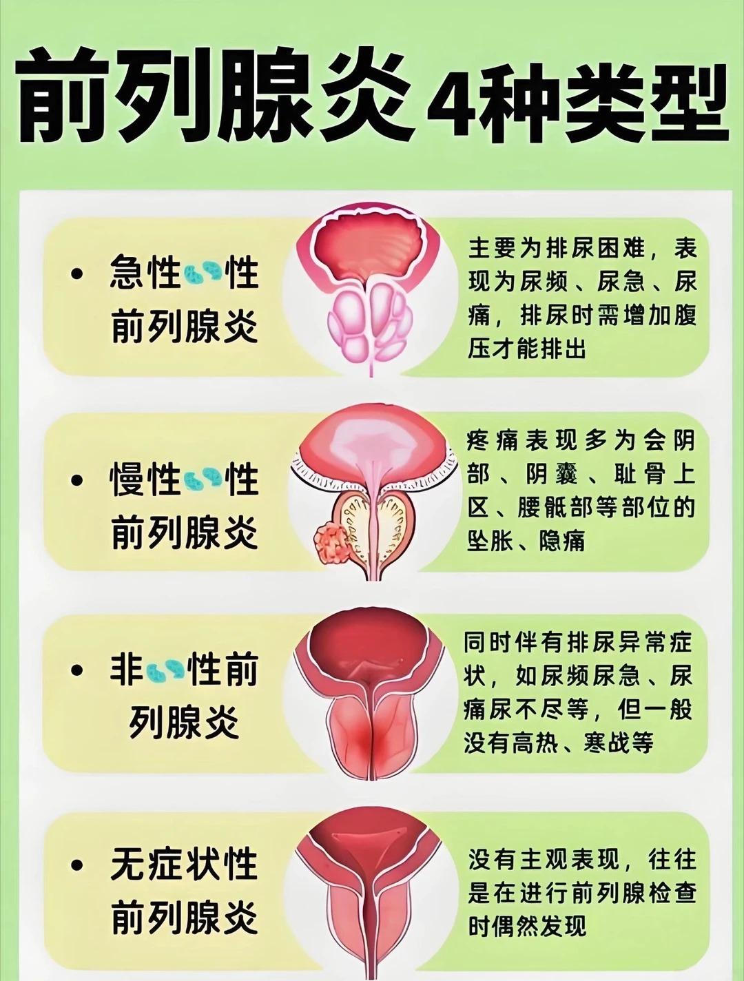 前列腺炎的4种类型