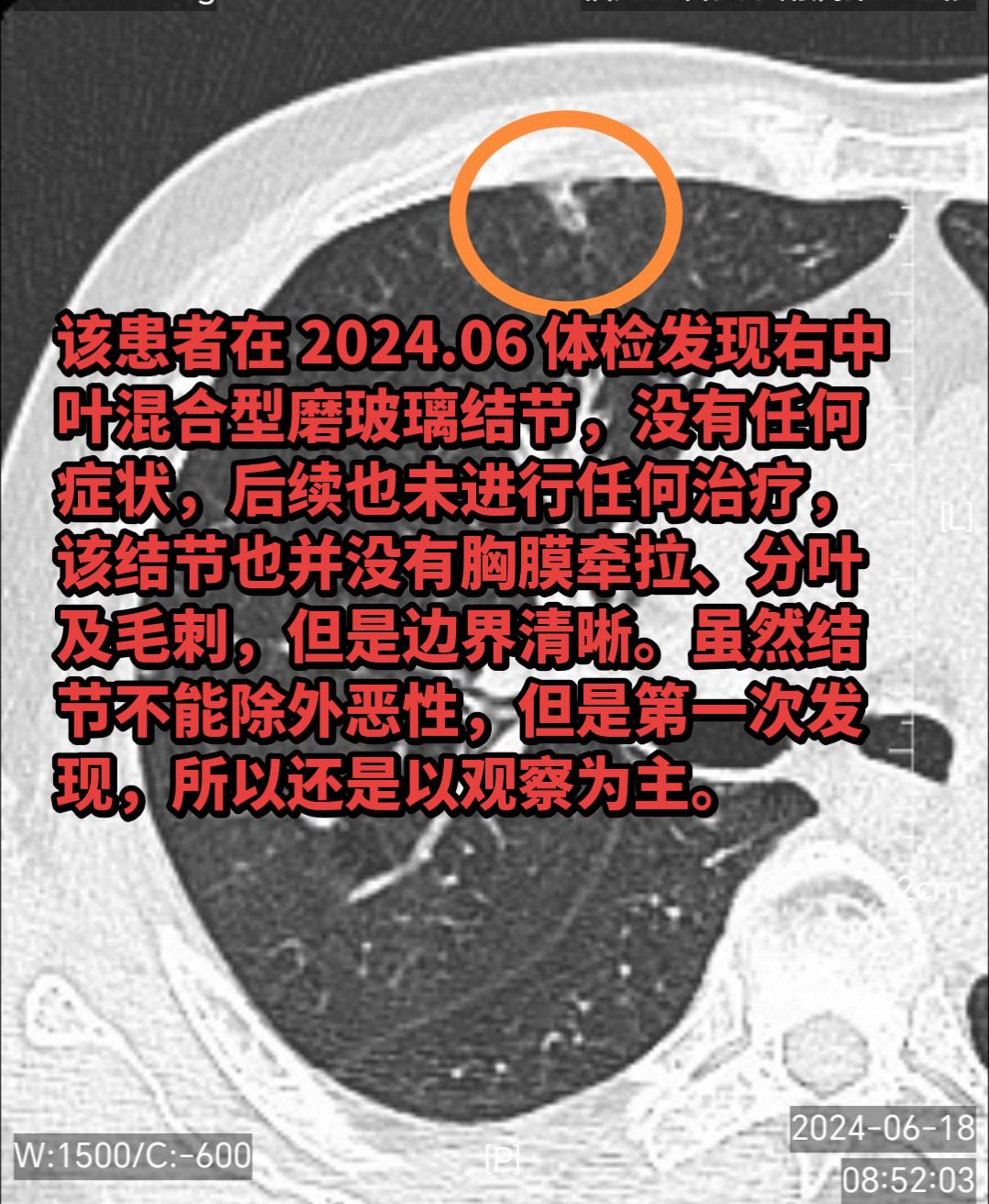 肺结节一年多的时间暴长几倍，是恶性吗？该患者在 2024.06 体检发...
