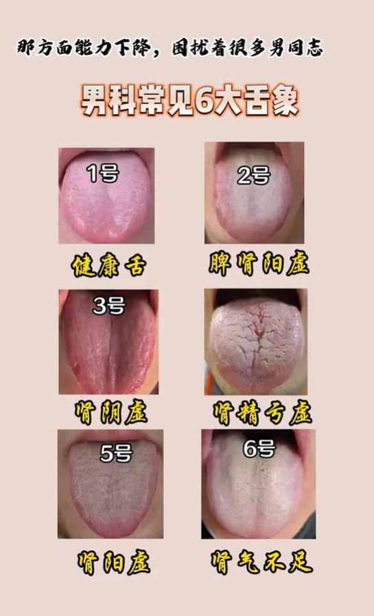 从舌象看男性体质：肾虚、阳虚的辨证要点