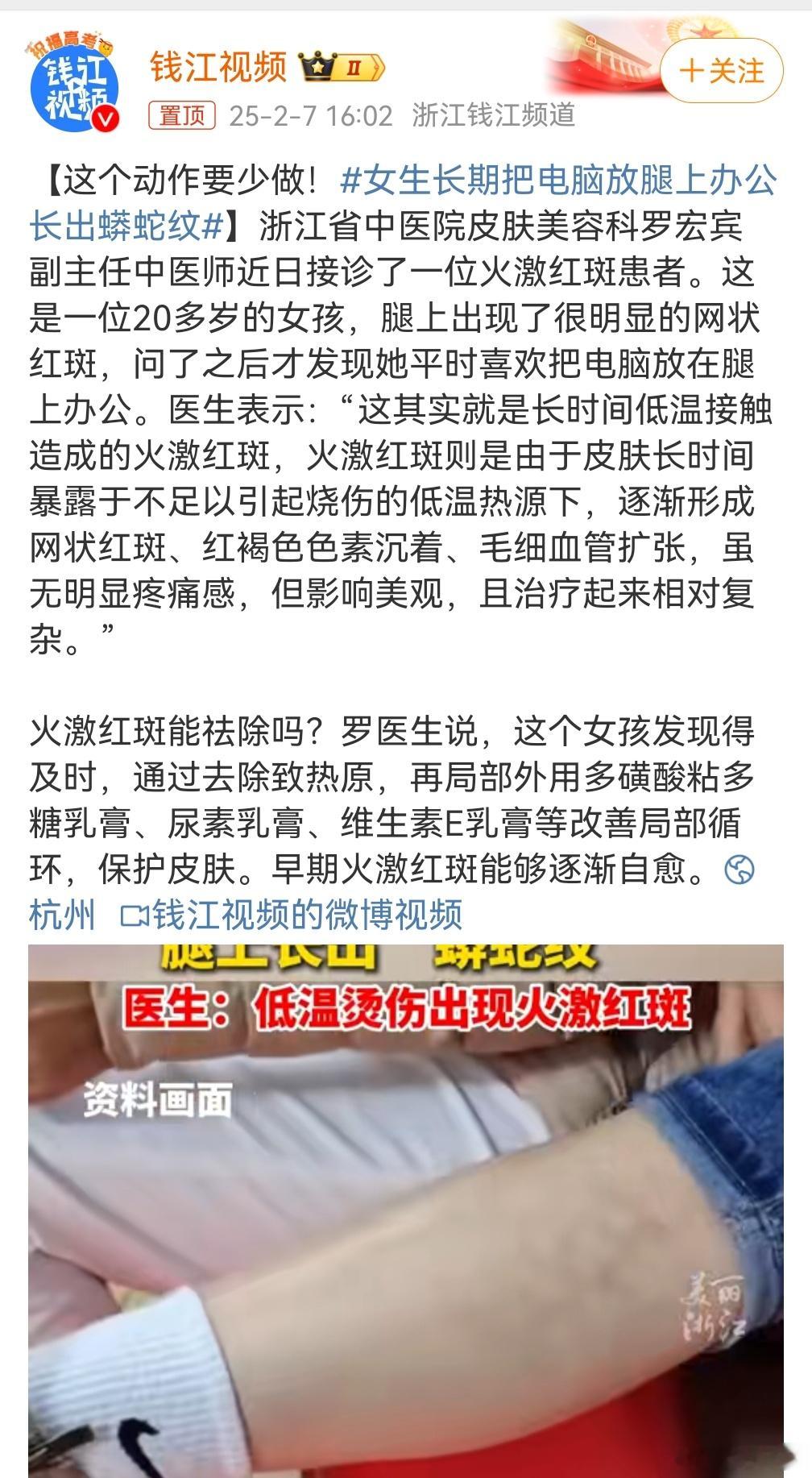 女生长期把电脑放腿上办公长出蟒蛇纹 长期放腿上？不理解，取暖吗？[笑cry][笑