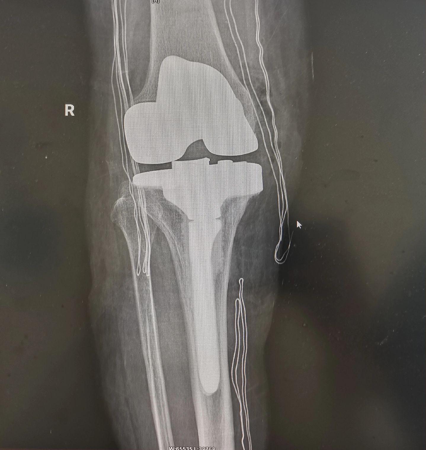 膝关节置换TKA.骨关节炎重度内翻合并屈曲挛缩畸形，无法行走，一期行双侧TKA，愿每一位患者都能得到有效的治疗，都能早日恢复正常生活🌹