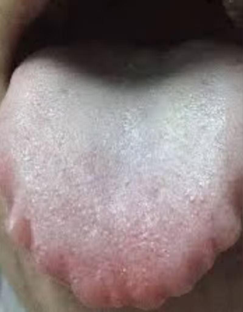 舌边齿痕别乱调！越祛湿越累？疏肝+健脾+补肾才是关键！
公益舌诊继续，有问题直接