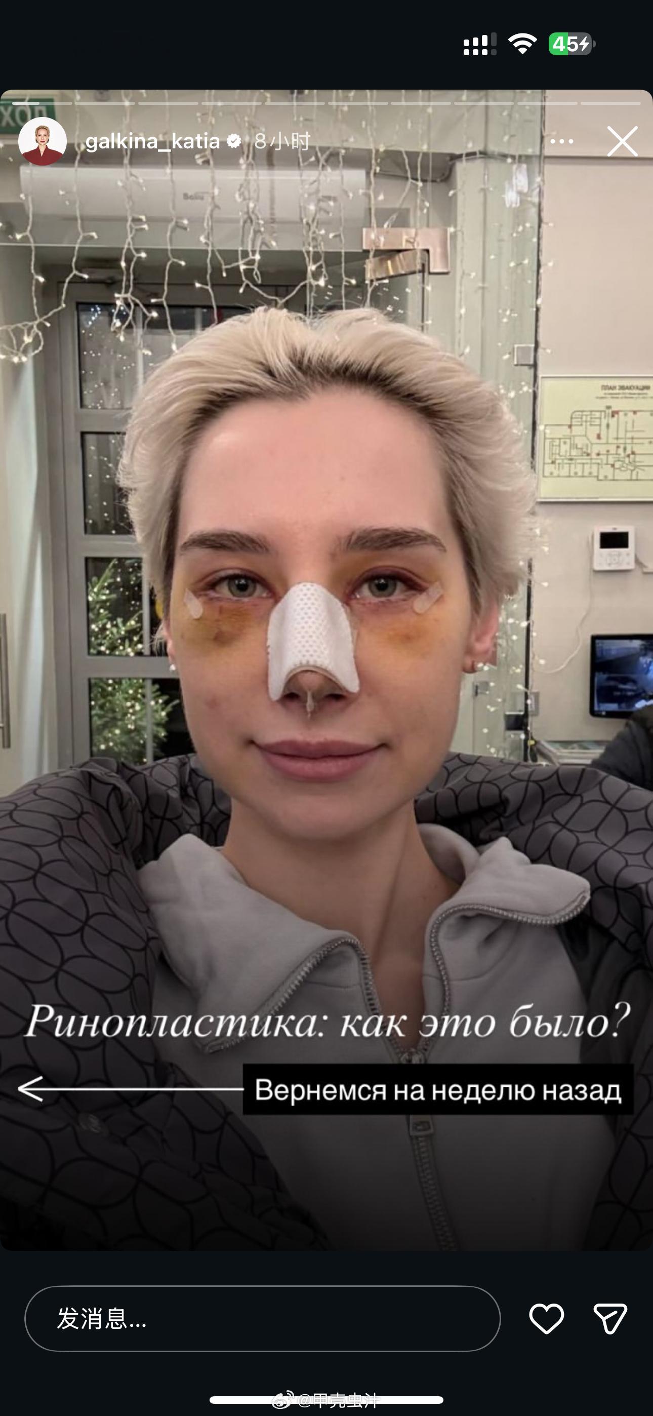 半夜刷到松鼠去做了隆鼻手术。。。 