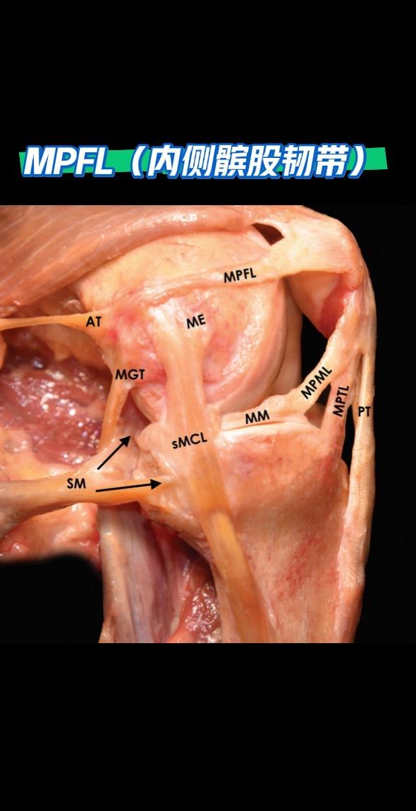 MPFL（内侧髌股韧带）