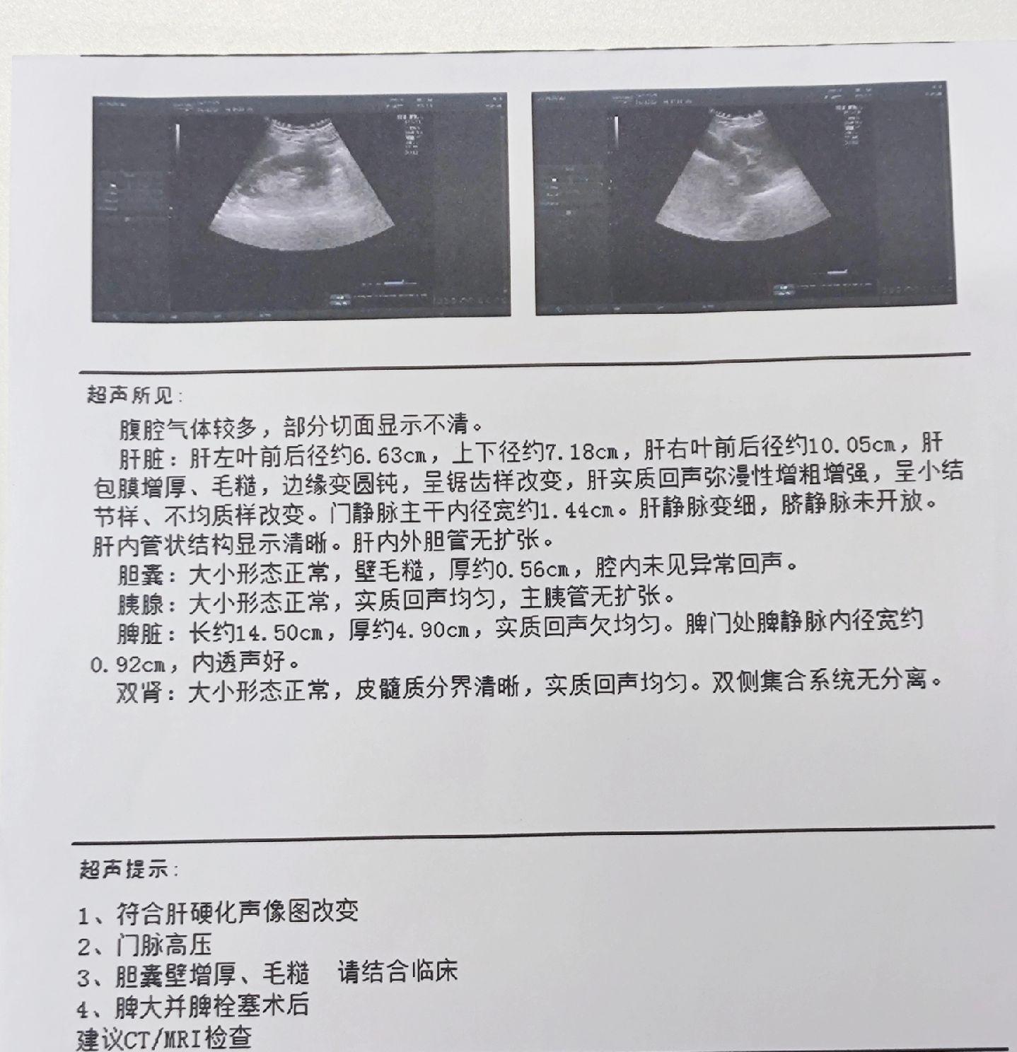 肝脏彩超以下5种情况一定要警惕！ ①肝脏实质回声增粗增强，可能提示肝脏...