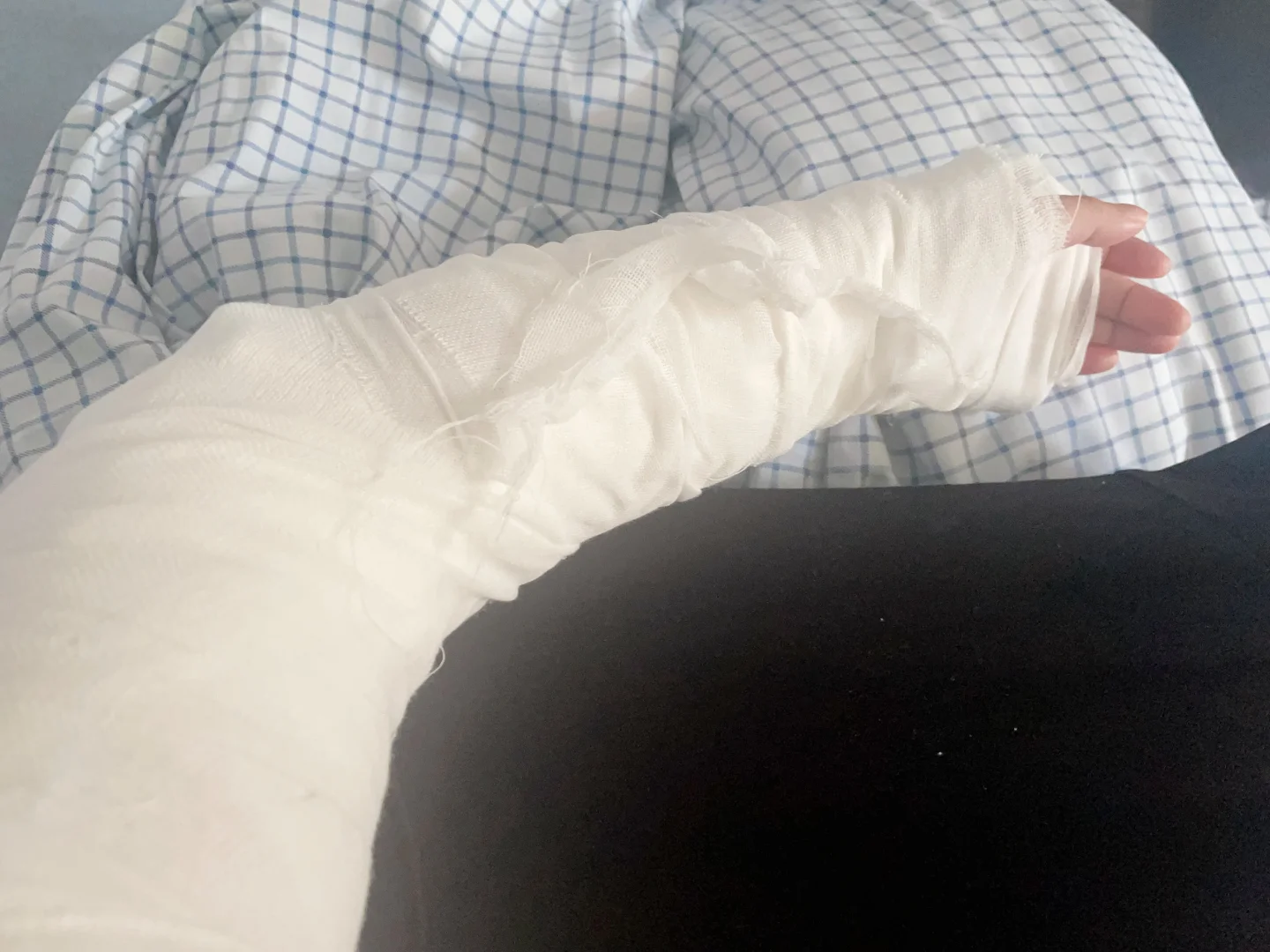 开启打石膏生活的第一天