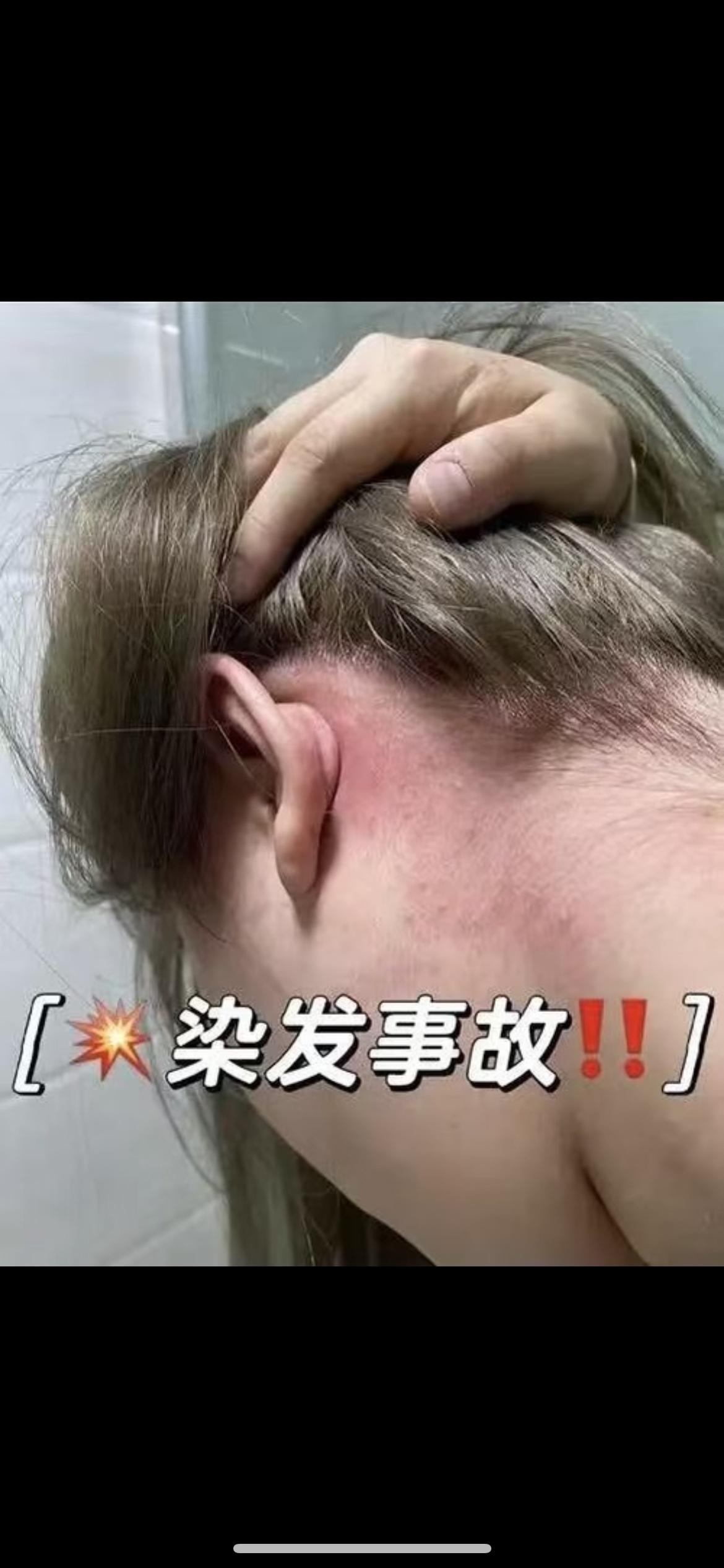 太揪心了！上海女子漂发后头皮溃烂流脓、头发大把掉，为了美付出的代价也太大了，这事