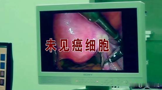 “无妄之灾！”湖北武汉，一男子胃疼，医生怀疑是胃癌，瞒着家属病人直接做了全切手术