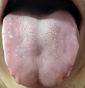 像这种舌头，毛病可真是不少，调理得慢慢来！

这个患者正值壮年，但是身体素质比同
