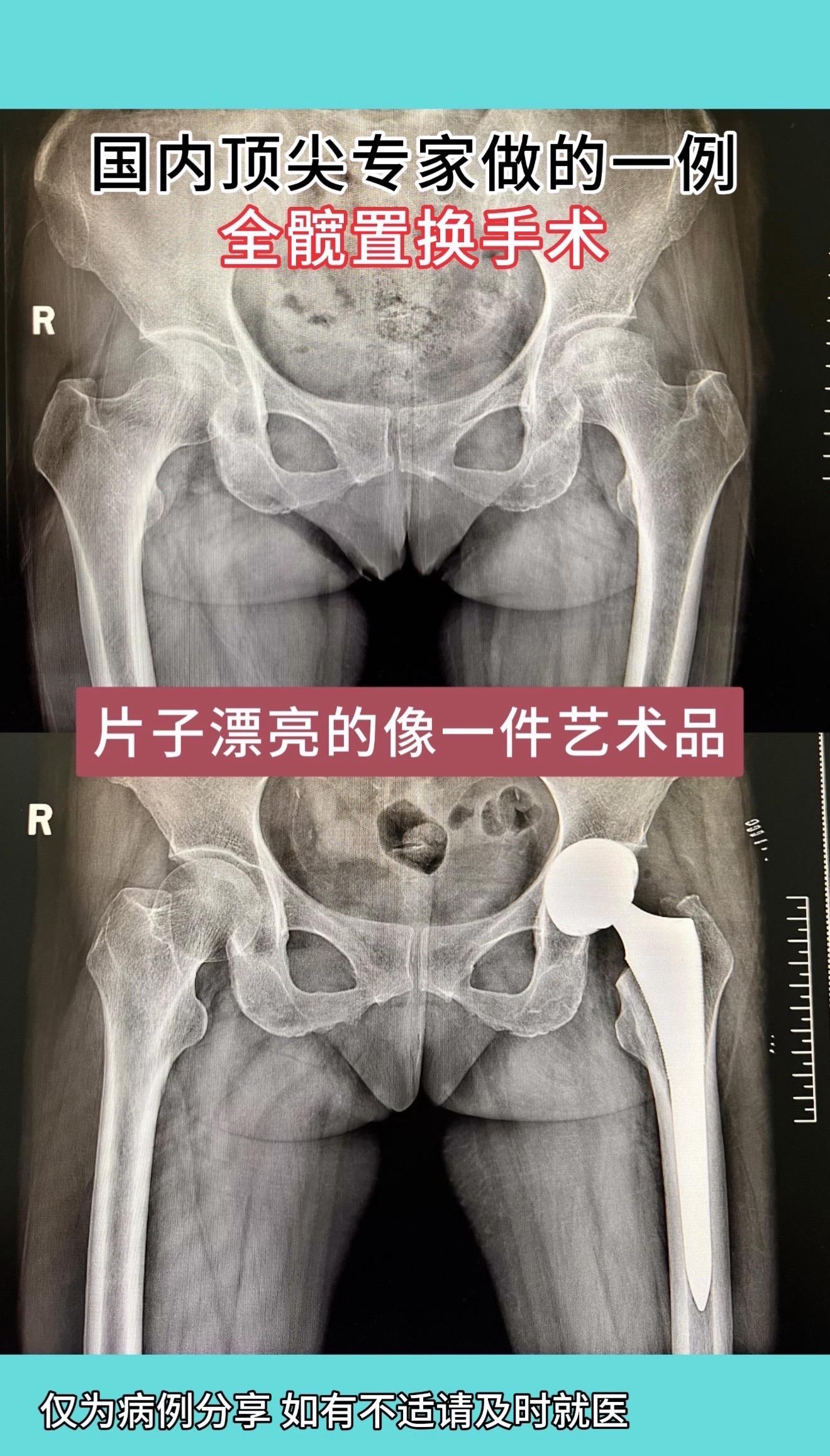 国内顶尖专家做的一例全髋置换手术：片子漂亮的像一件艺术品，术后症状缓解...