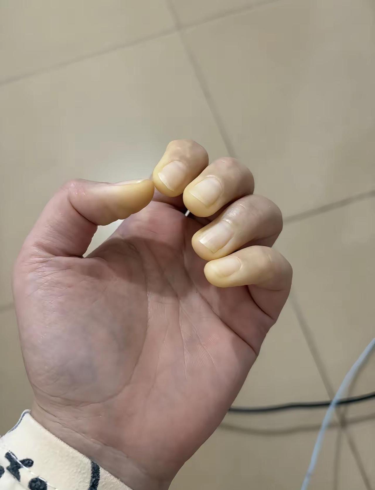 深圳今天进入夏天 突发的降温，又一波雷诺来袭！这种感觉很不适干燥综合征 雷诺现象