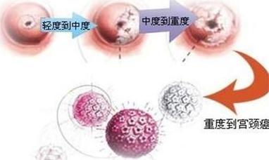 宫颈癌浸润深度和宽度 到底哪个更重要？
很多姐妹拿到病理报告后，最容易被两个词吓