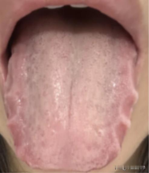 久病必有瘀！这样的齿痕舌，你要是光知道健脾利湿，属于杯水车薪
病人主诉：乏力、疲
