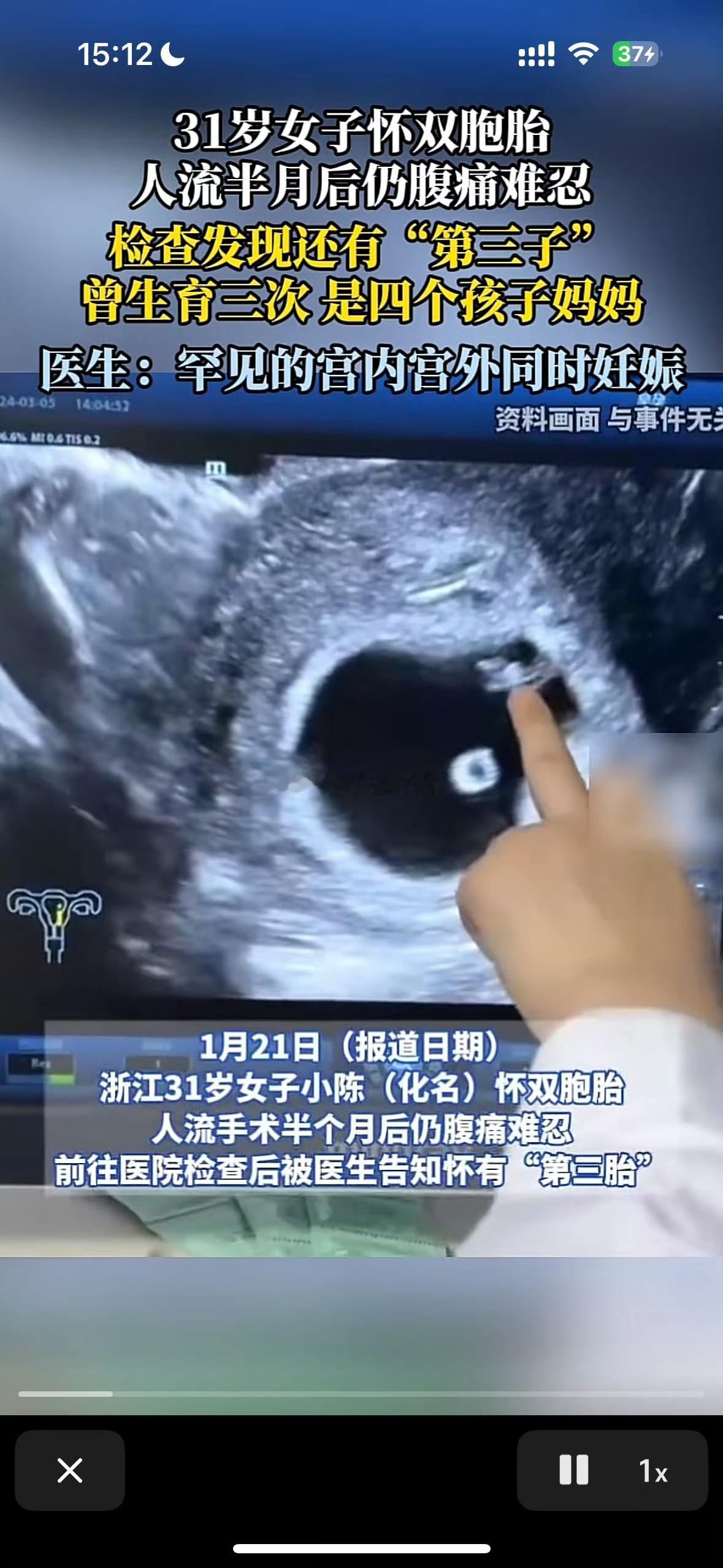 浙江31岁女子双胎人流后腹痛不止，检查竟发现腹中藏着“第三子”！这起罕见病例太令