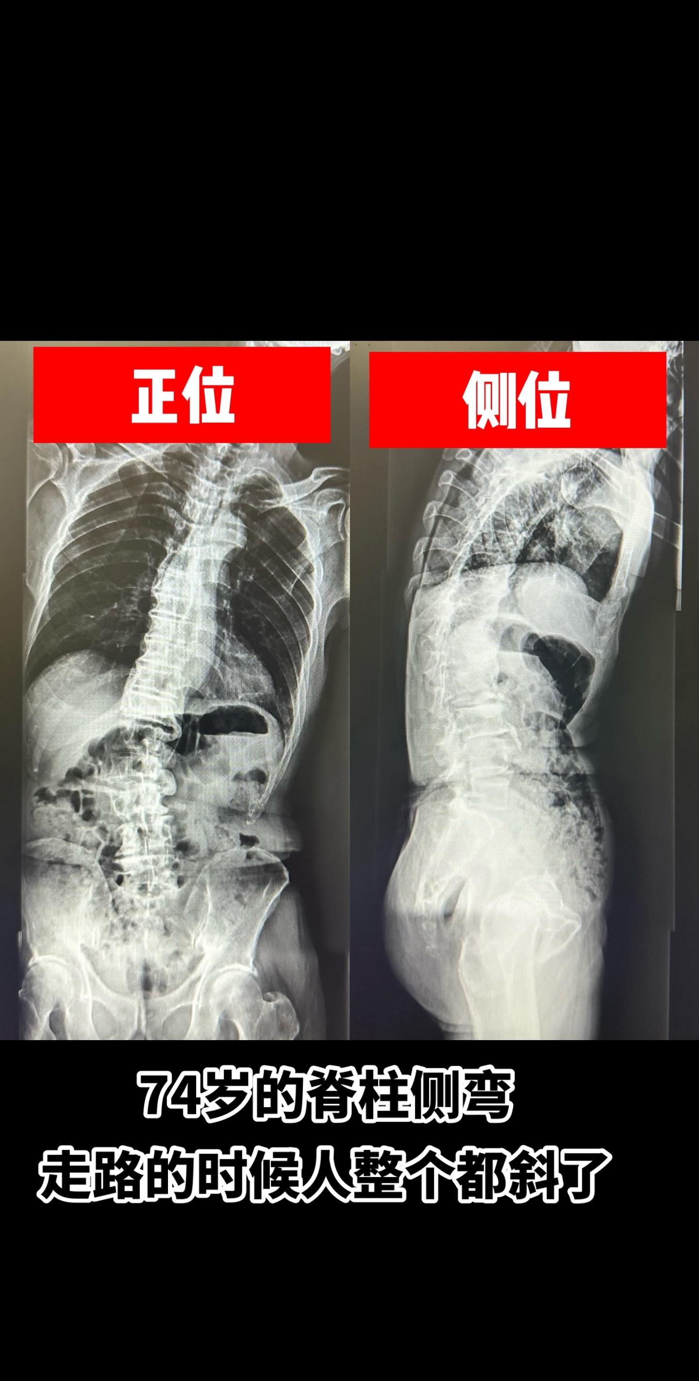 早上门诊的一个老爷爷，已经74岁，走路向一边倾斜，拍了一张全长X光片...