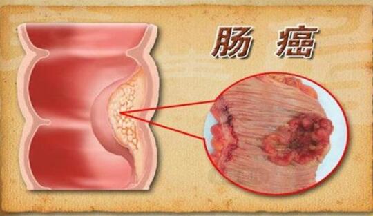 结肠癌的分期：早期、中期、晚期如何判断？